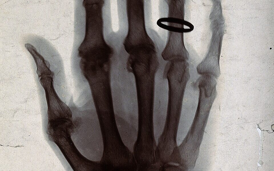 Röntgenbild einer Hand mit Ring am Finger